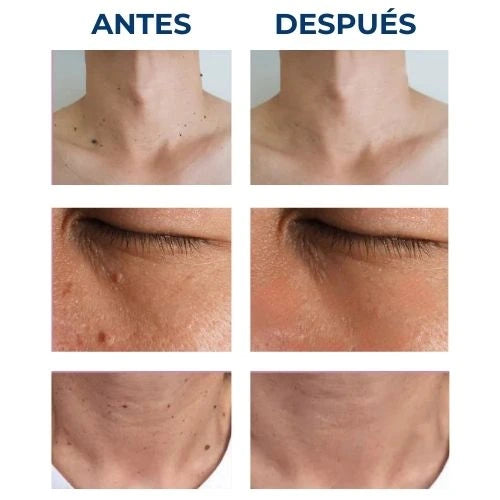 Luminiix® - Eliminador de Verrugas