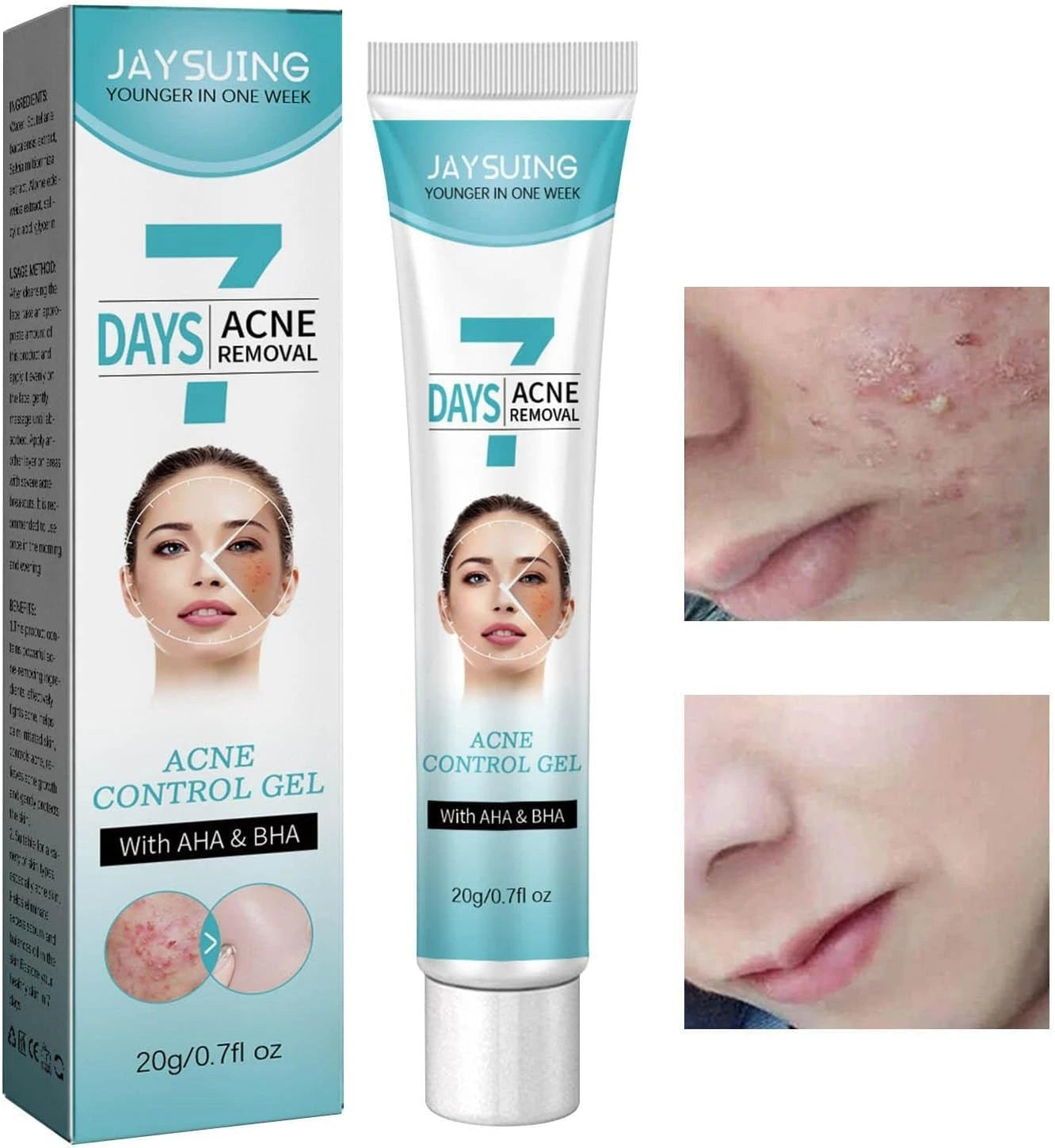 Crema facial acné tratamiento FK23B-39