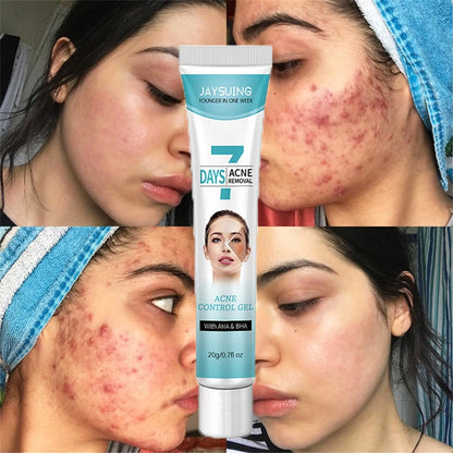 Crema facial acné tratamiento FK23B-39